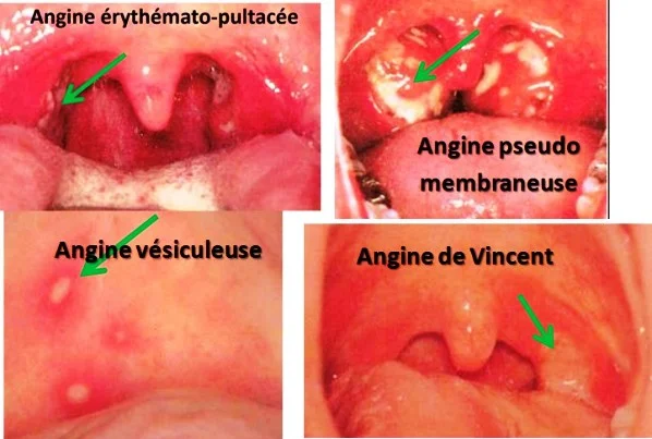 Angines Amygdalite aiguë, semiologie et formes cliniques