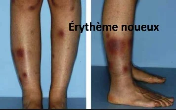 érythème noueux érythème noueux, streptocoque