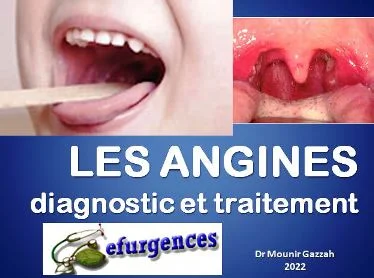 Diaporama les angines diagnostic et traitement angines et pharyngites, traitement