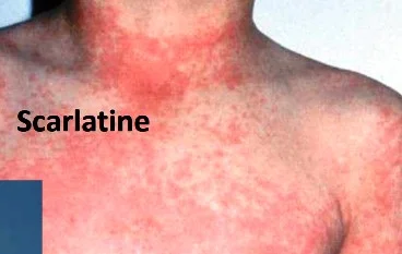 Scarlatine Scarlatine, érythème cutanée
