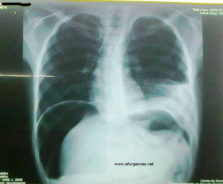 Radiographie de thorax