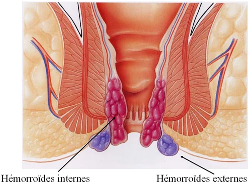Hémorroïdes, anatomie du canal anal, proctologie Hémorroïdes, anatomie du canal anal, proctologie