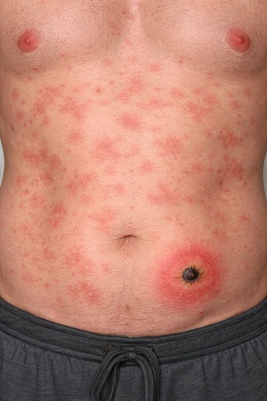 escarre et signes cutanés des rickettsioses