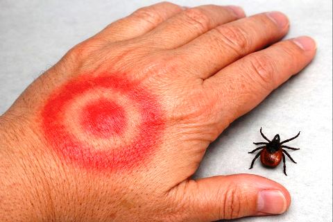 maladie de Lyme, signes cutanés