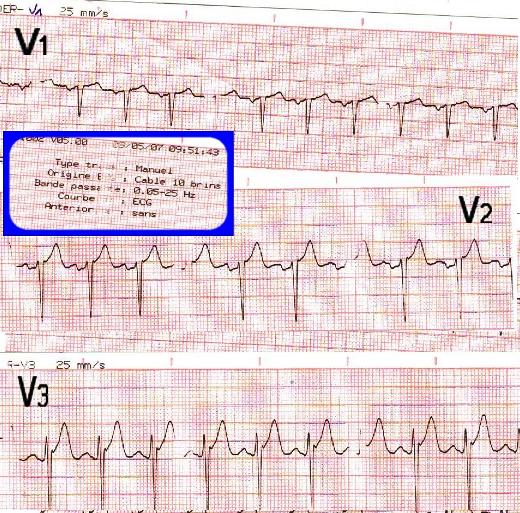 filtres ECG