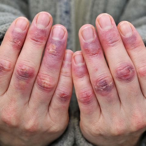 engelure des mains, exposition au froid