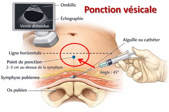 Retention urinaire, ponction sus-pubienne