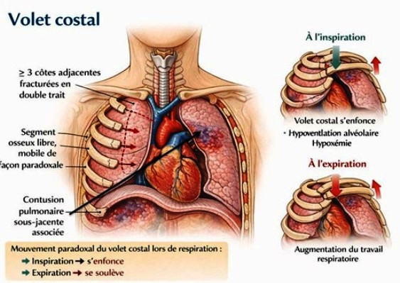 Volet costal, traumatisme du thorax